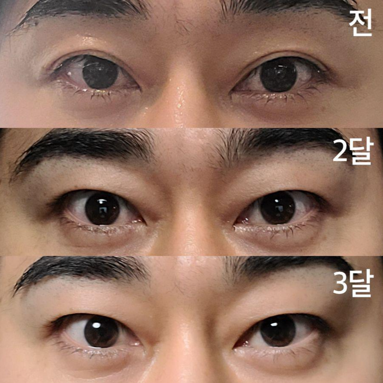 做了雙眼皮切開術3個月了。