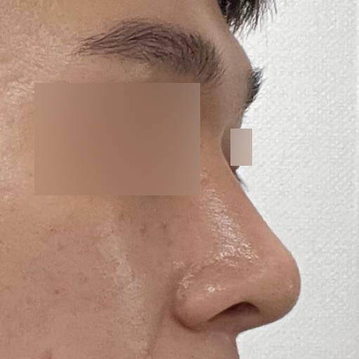 給徐承祖院長做鼻子手術已經2個月了。