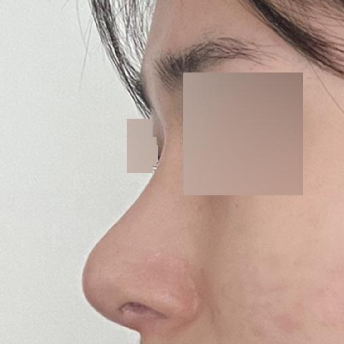 在維弗斯整形外科醫院做隆鼻手術已經兩個月了。