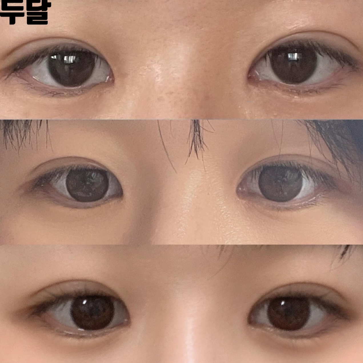 給沈正煥院長做了眼鼻手術兩個月後的後記