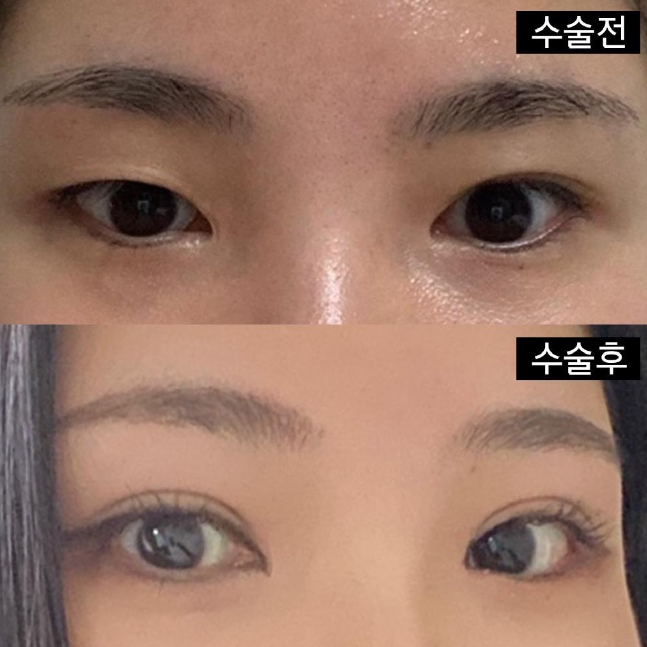 如果是雙眼皮，眼睛修復手術，我強烈推薦您來這裡