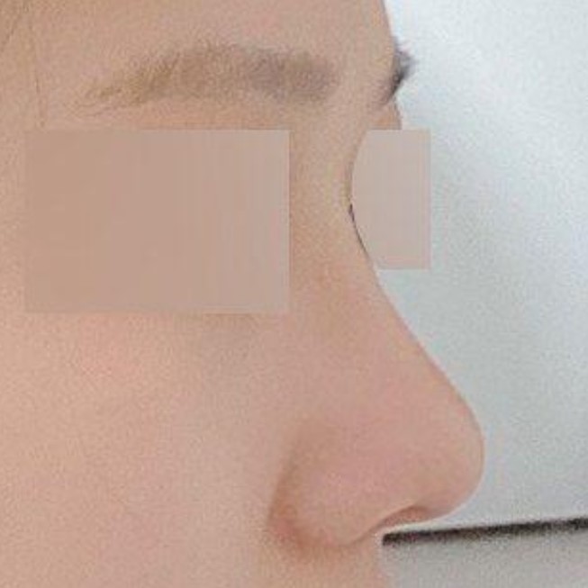 鼻樑挺起來後，側臉也變漂亮了，立體感也增強了！