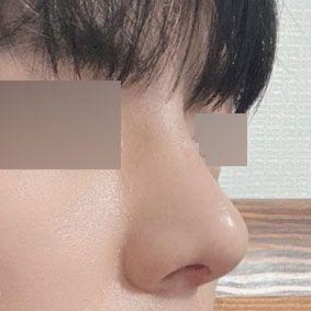 做了鼻炎手術，也算是自我管理