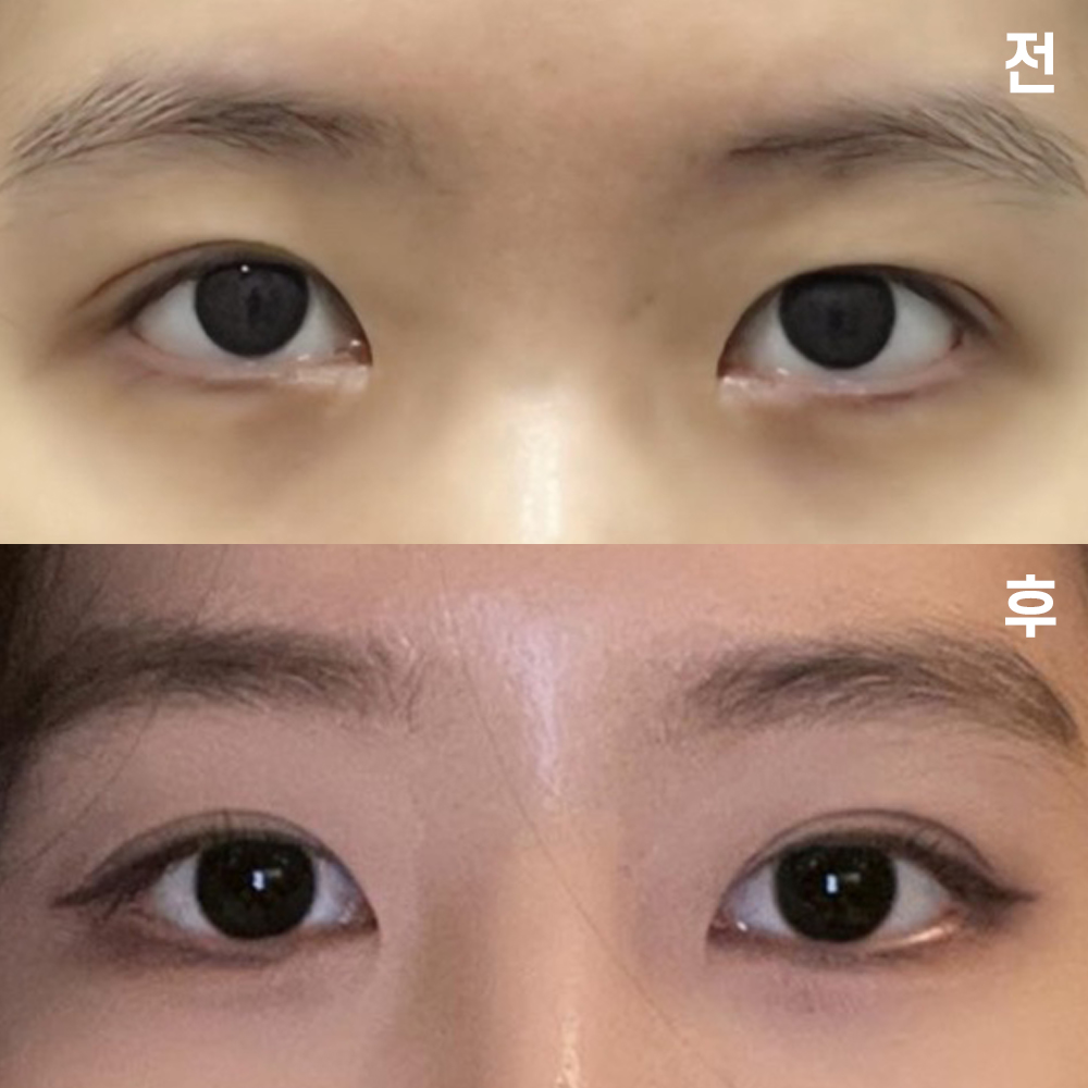 在維沃斯整形外科做手術已經1個月了~! 