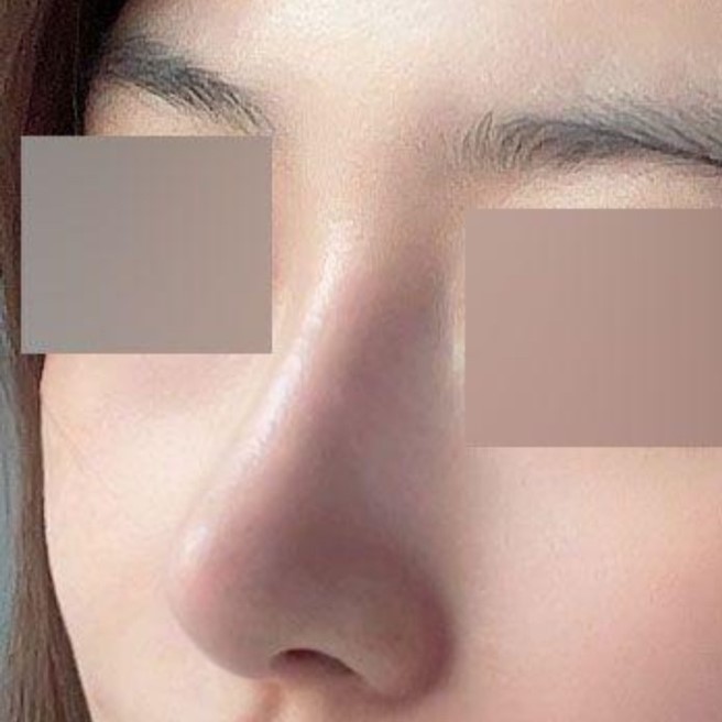 鼻子重做手術後，沒事經過了3個月，呵呵
