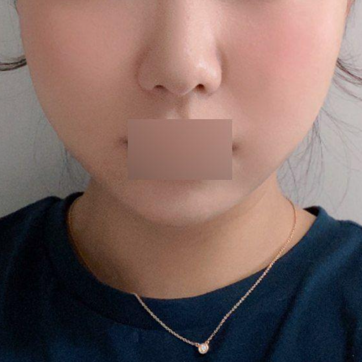 給沈正煥院長做了埋線拉提，已經1個月了