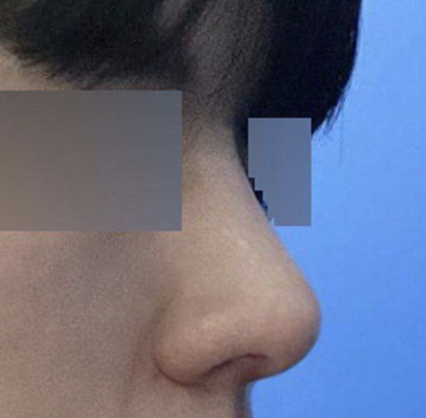 現在我明白為什麼人們說男人要隆直鼻了 哈哈哈