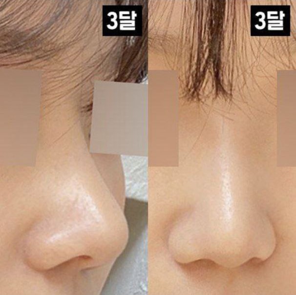 鼻樑鼻尖都很滿意！