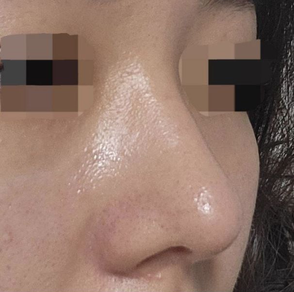 苦惱了很久才進行的手術，一點也不覺得浪費錢，非常幸福！