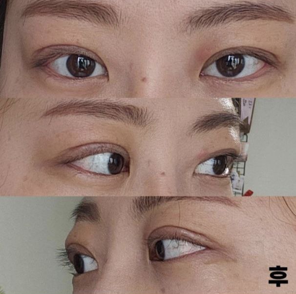 我覺得做手術真是太好了