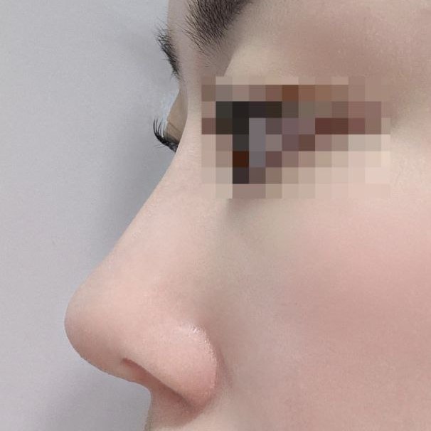 我很喜歡！非常期待一個月後消腫的樣子！