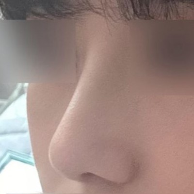 即使是第一次做隆鼻手術，也非常非常滿意，滿意度高達3728299393829%