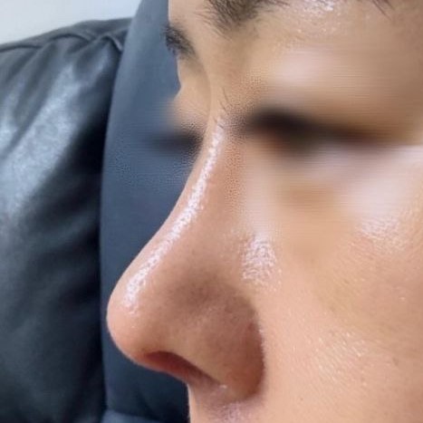 一直很苦惱鼻尖塌陷，現在有了鼻尖真是太好了^^