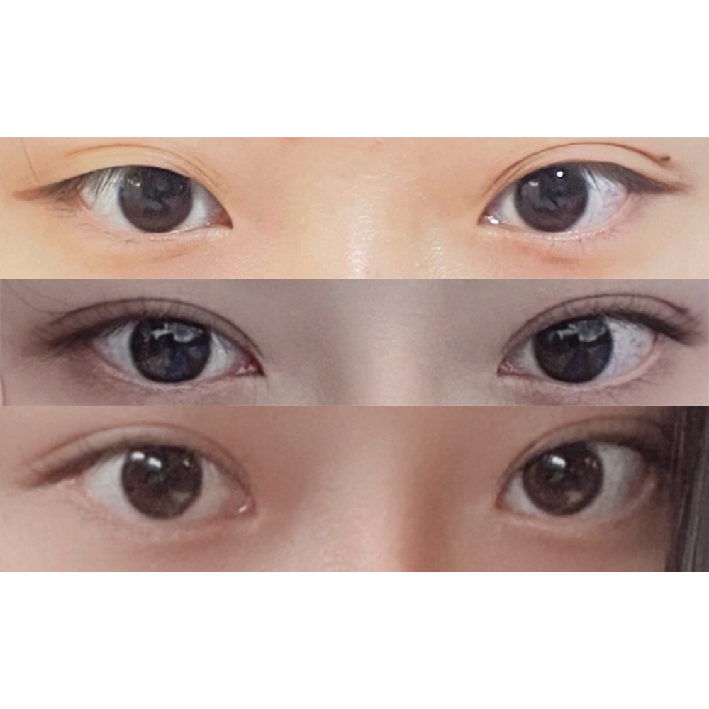 眼睛、鼻子一起做了手術ㅎㅎ