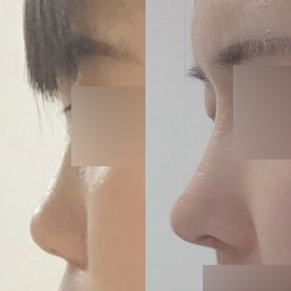 做完眼鼻手術已經8個月了！