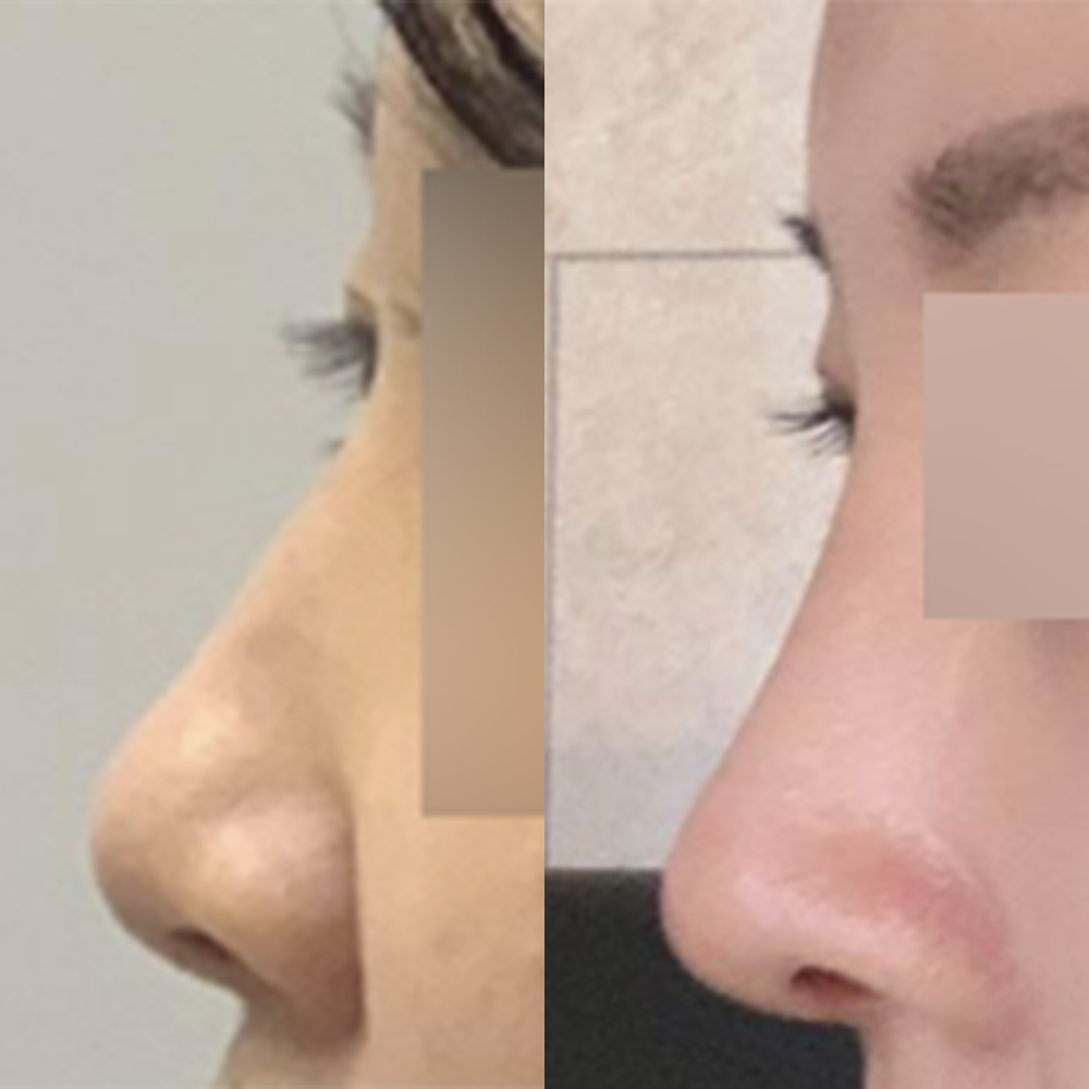 做了第一次隆鼻手術！