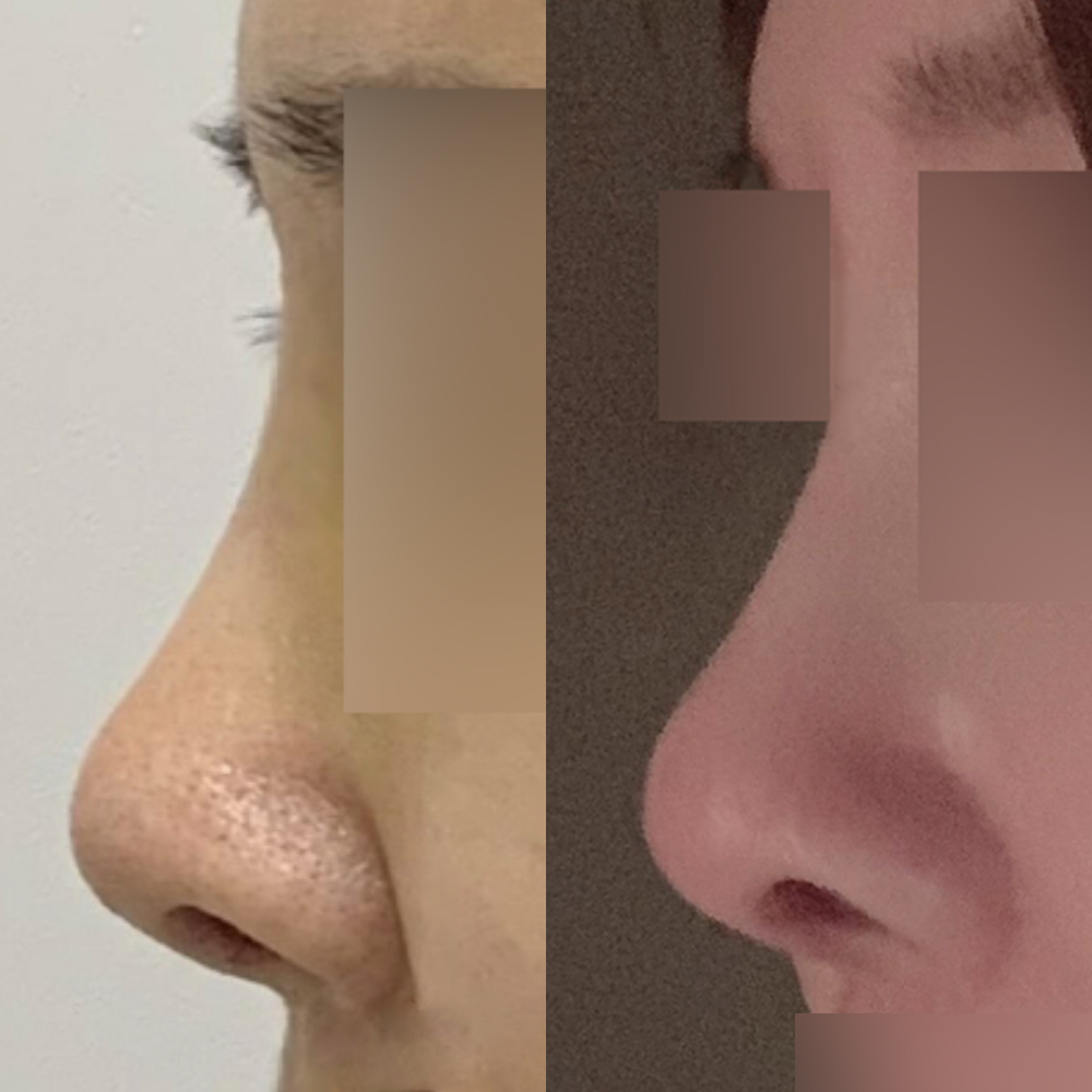 5年前突然做了隆鼻手術:-)))