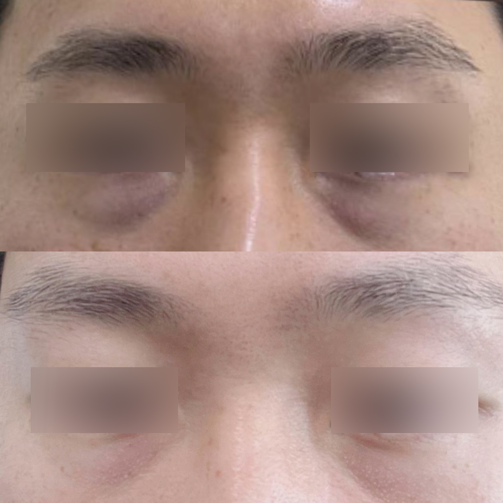 眼下脂肪重新定位手術後 2 個月的評論 :)