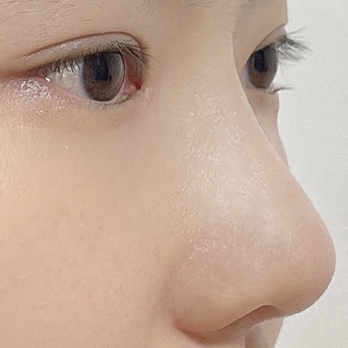 我在四月份在月海做了眼鼻手術，現在已經兩個月了，哈哈