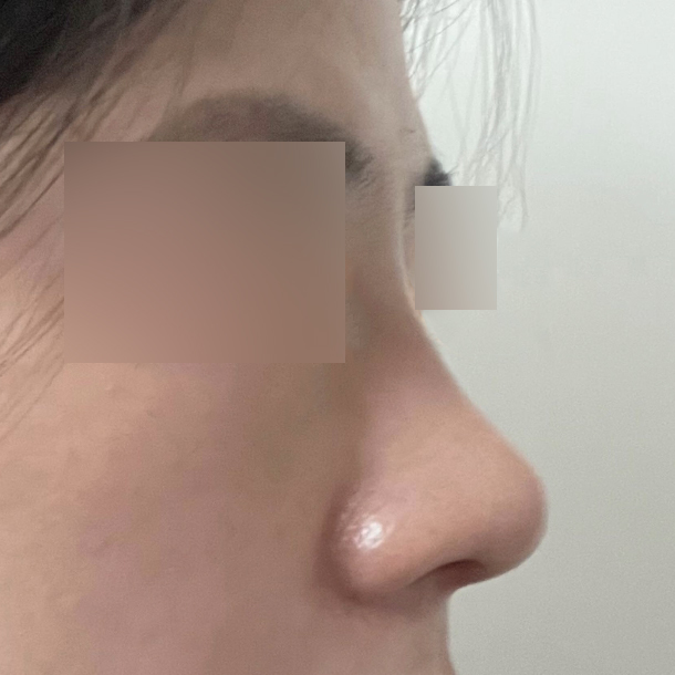 做了縮鼻頭手術