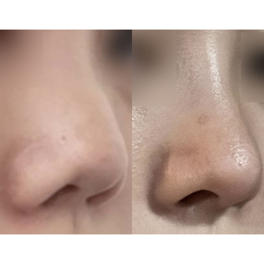 做完隆鼻手術才一個多月！