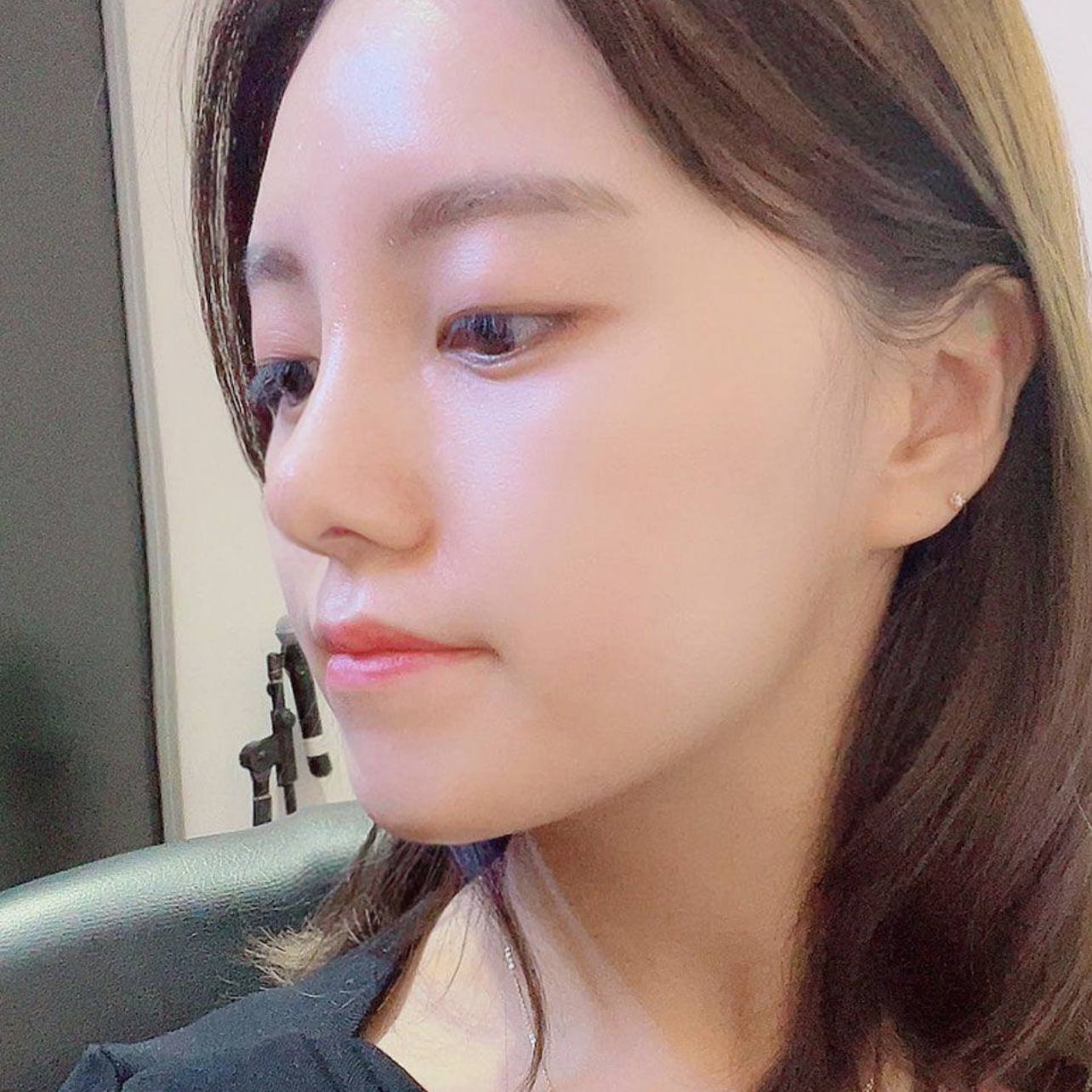 在Wivers整形外科做完隆鼻手術一個月了