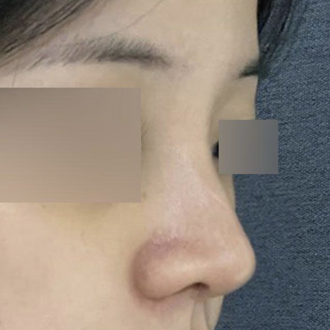 手術已經兩週了