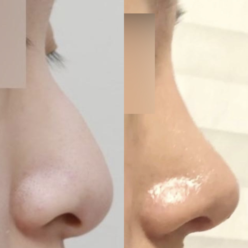 第一次做鼻部整形手術，沒有植入假體！