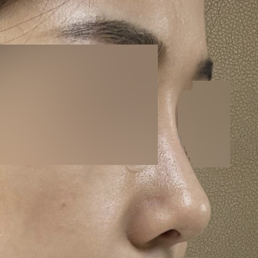 手術後三個月多一點的後記～