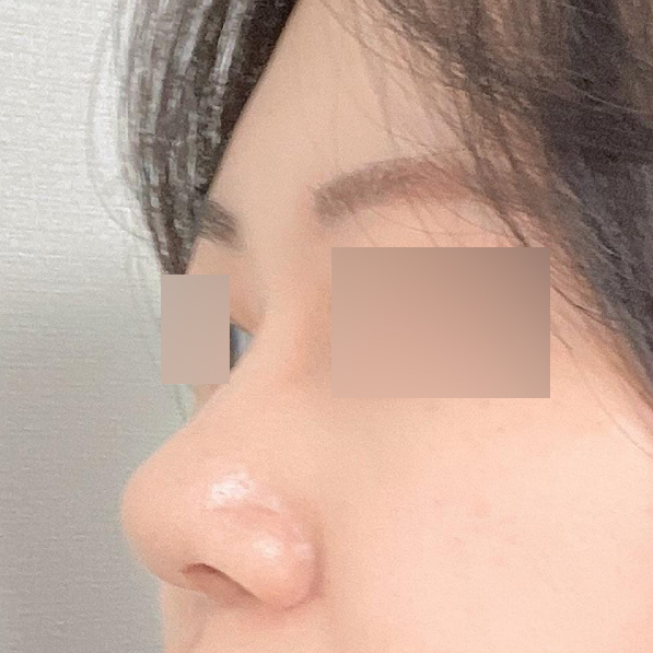 手術三個月後記