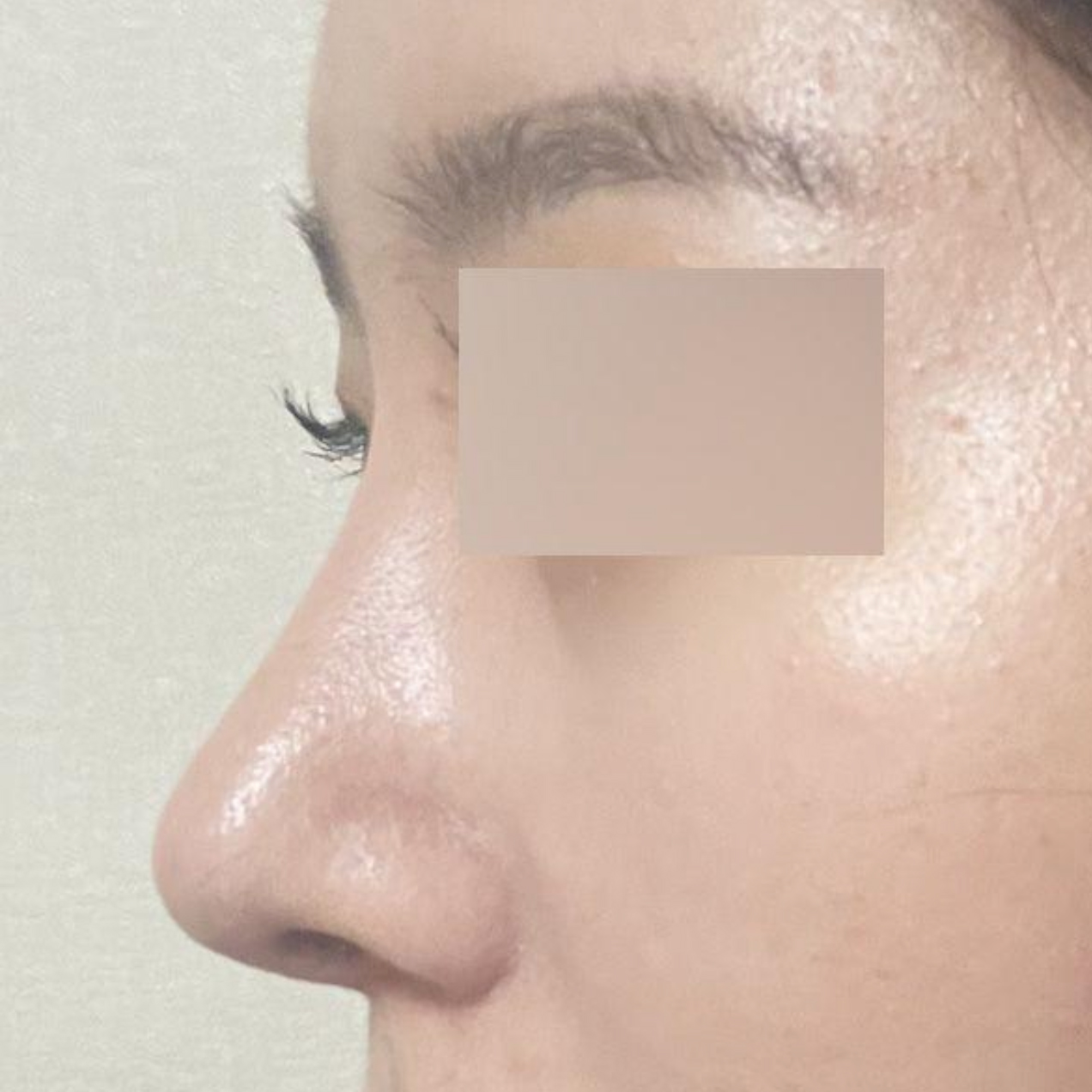 做了蒜頭鼻手術兩週了