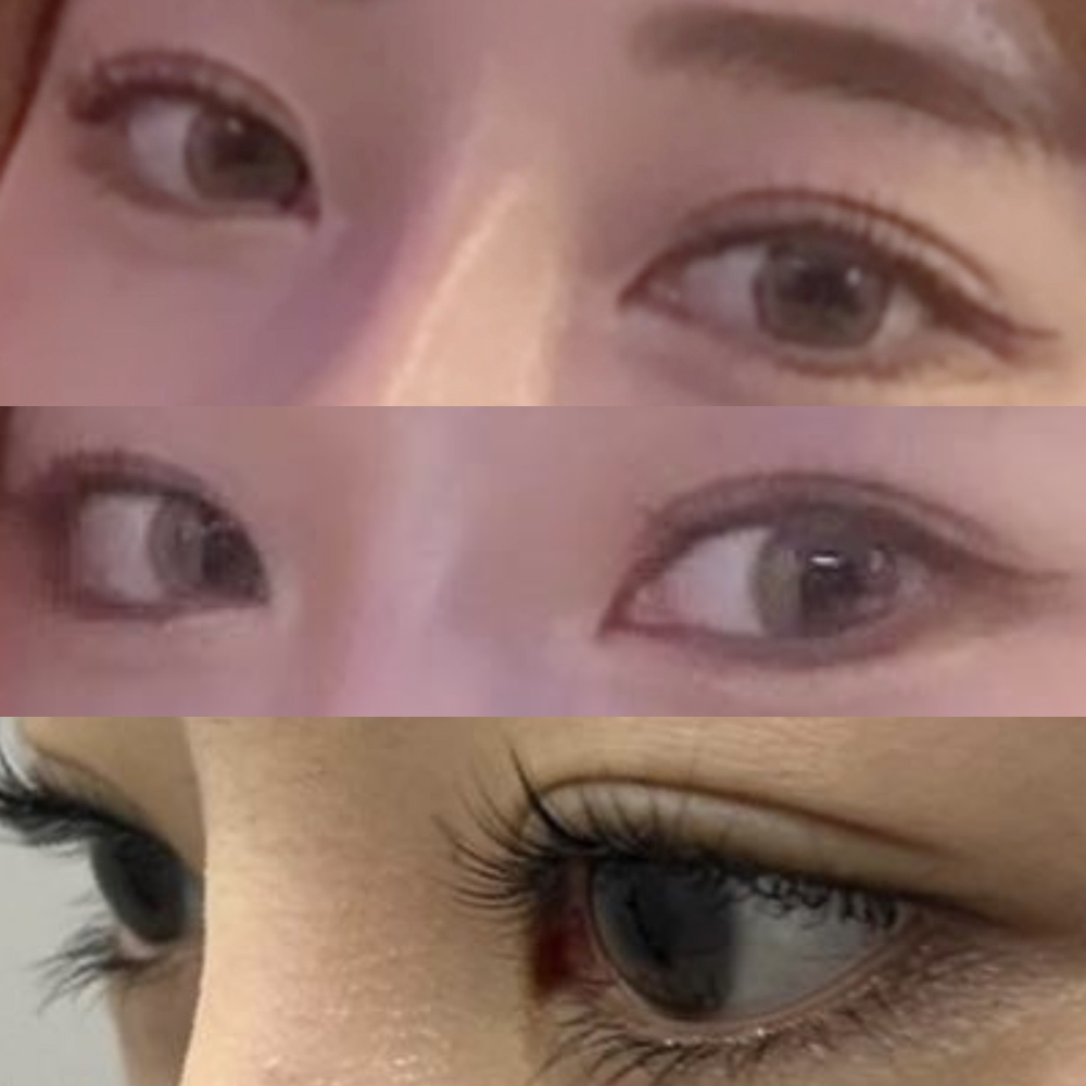 做完眼部手術已經一個月了~~