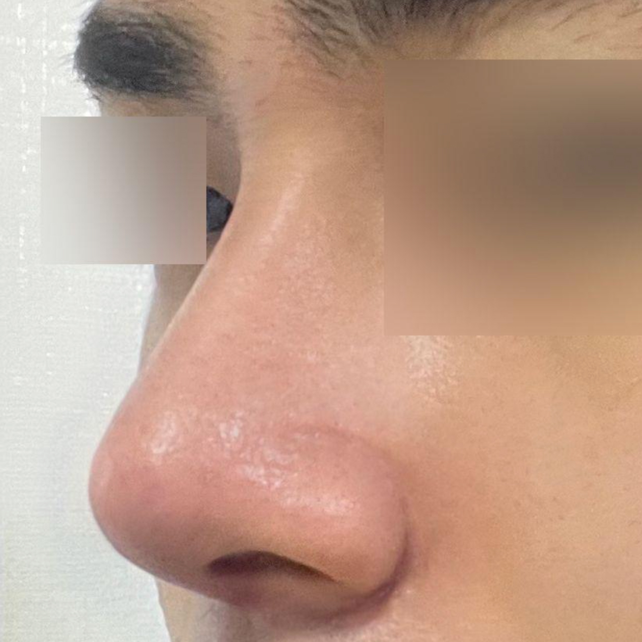 在韋伯斯整形外科做完手術已經兩週了。