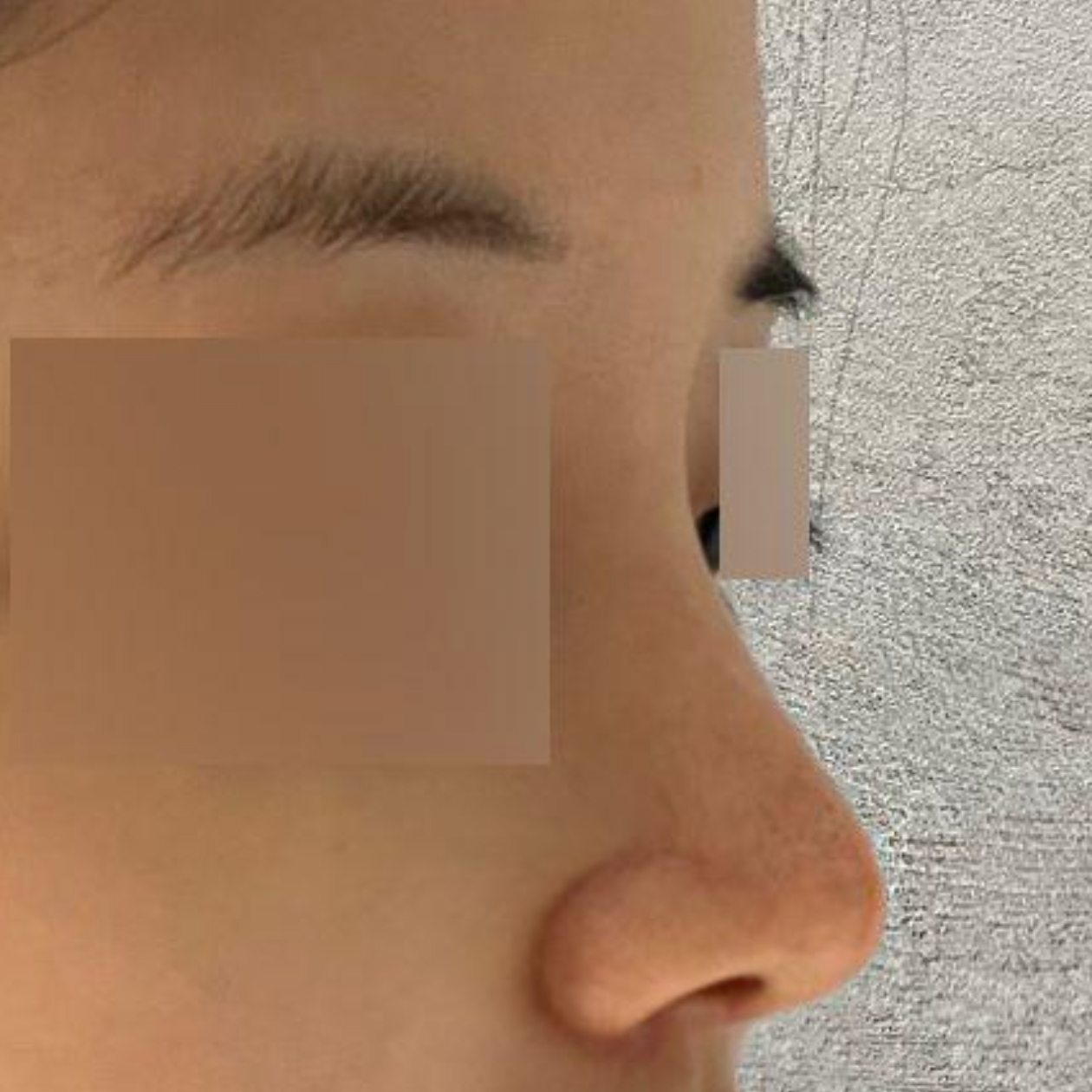 手術已經兩個月了