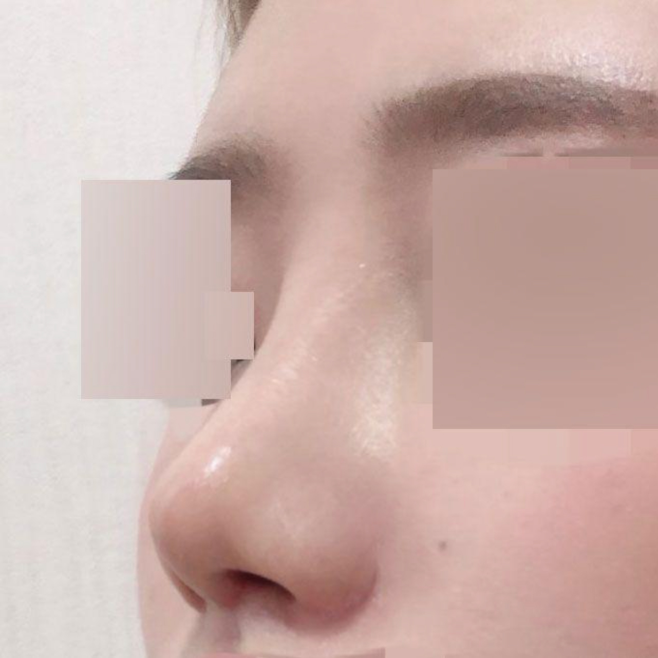 做了蒜頭鼻再手術！