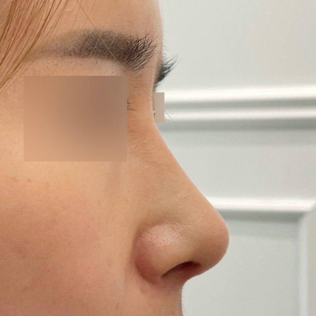 手術做得非常漂亮^^