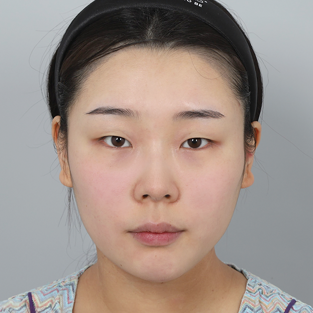 #部分切開 #開眼頭 #去除上眼皮脂肪 #鼻樑（矽膠） #鼻尖（自體軟骨）