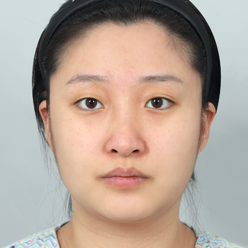 #部分切開 #鼻尖（自體軟骨） #無假體隆鼻 #鷹鉤鼻矯正 箭頭鼻矯正