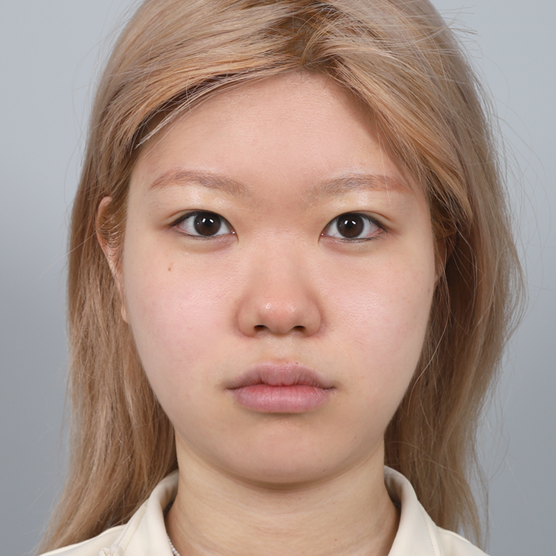 #鼻樑（矽膠） #鼻尖（自體軟骨） #蒜頭鼻矯正