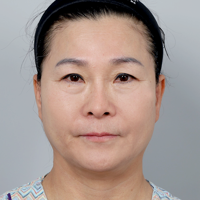 #下眼瞼 #額頭拉提（內視鏡）面部拉提