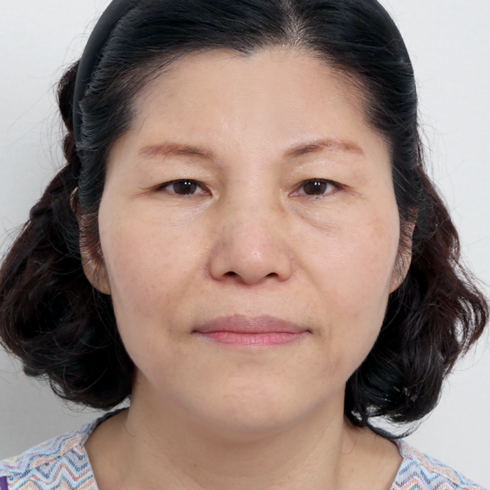 #下眼瞼 #額頭拉提（內視鏡）面部拉提