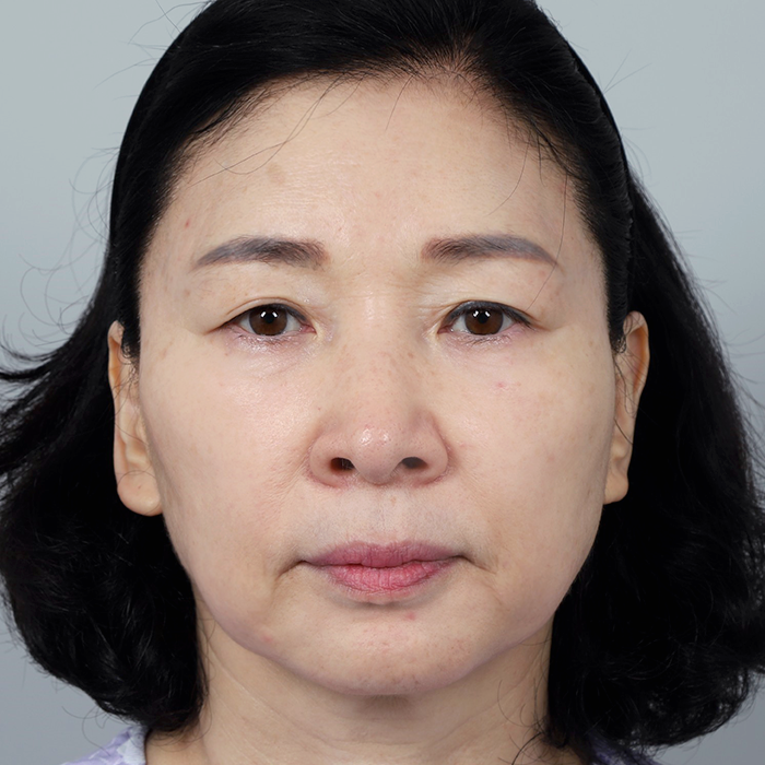 #上眼瞼 #下眼瞼眉下提拉面部拉皮