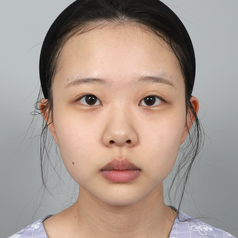 #部分切開 #上眼瞼提拉 #鬆解粘連 #鼻樑（矽膠） #鼻尖（自體軟骨）眼部修復手術