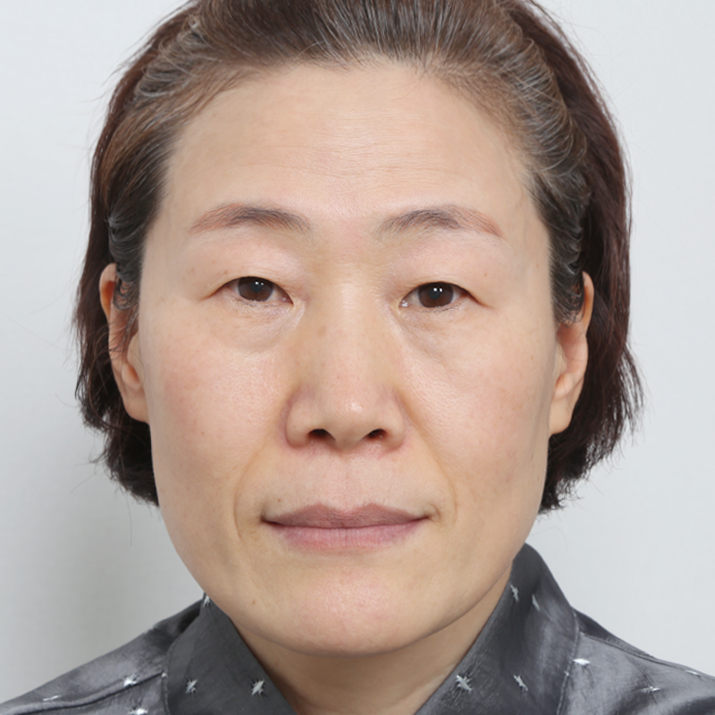 #非切開（埋線）#後開眼角+下眼瞼下至#下眼瞼切除