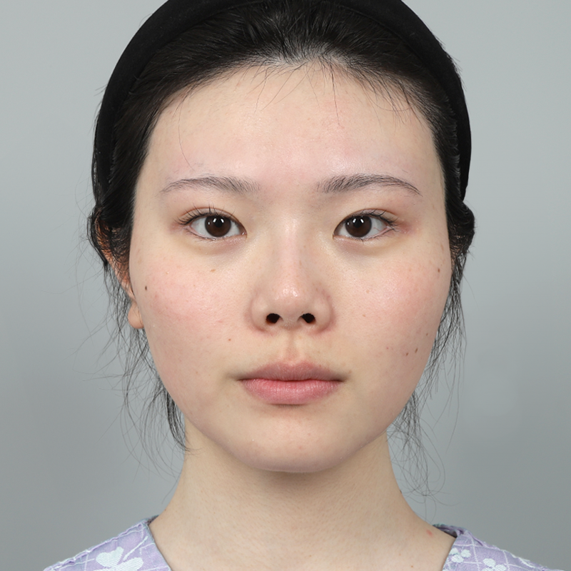 #鼻樑（矽膠） #鼻尖（自體軟骨） #自體肋軟骨隆鼻 #短鼻（朝天鼻）矯正