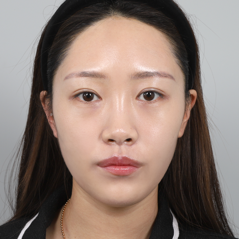 #鼻樑（矽膠） #鼻尖（自體軟骨） #眼下脂肪重置全臉脂肪移植