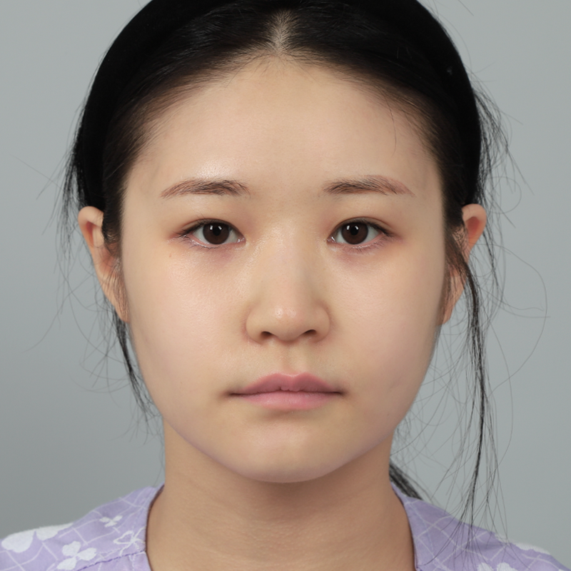 #鼻樑（矽膠） #鼻尖（自體軟骨）