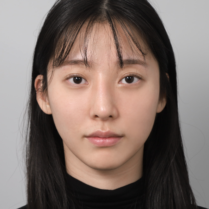 #鼻尖（自體軟骨） #無假體隆鼻 #駝峰鼻矯正 #鼻重修手術